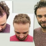 The Cost Of Travelling To The USA For Hair Transplants