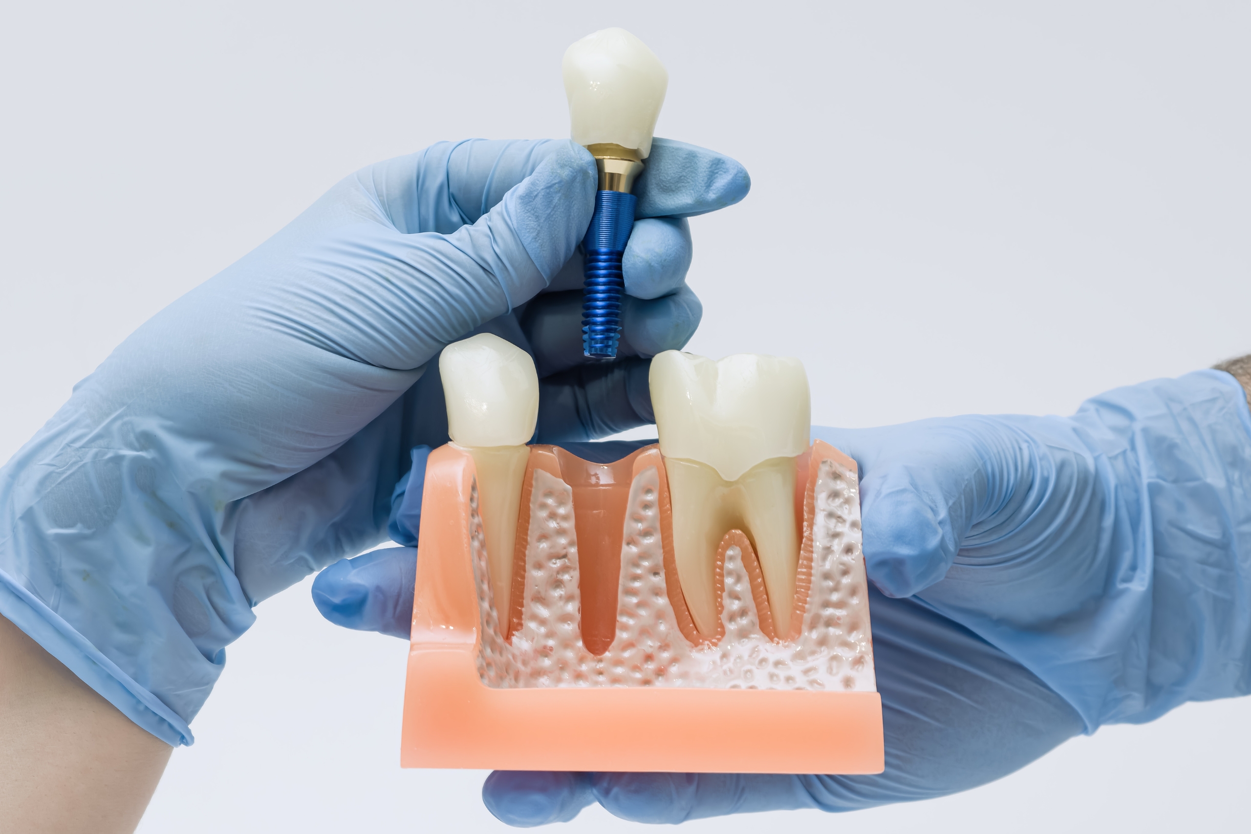 Important Factors To Consider Just Before Having Dental Augmentations Abroad