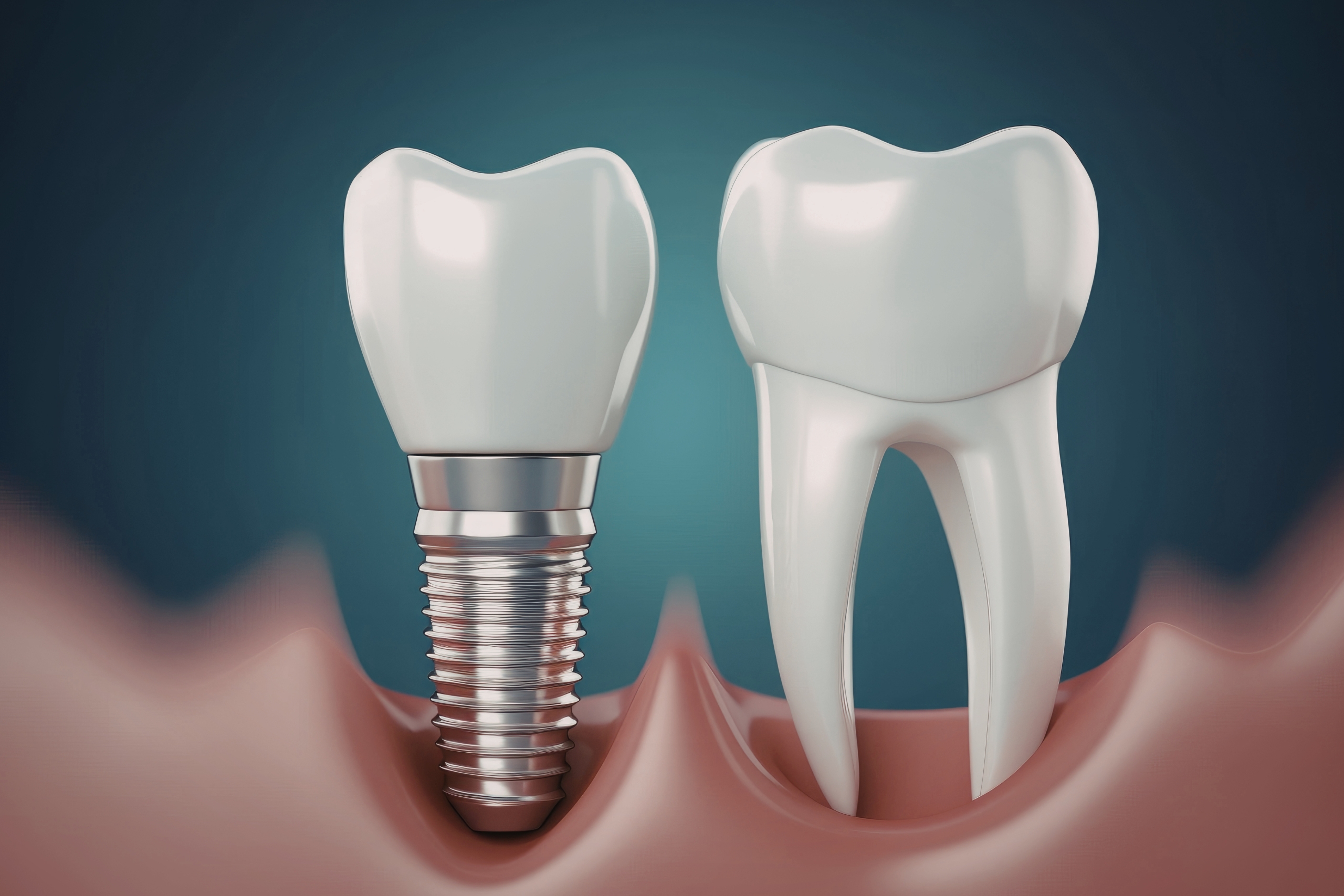 Oral Implants – Explanations Why People Go In foreign Countries For Dental Implants