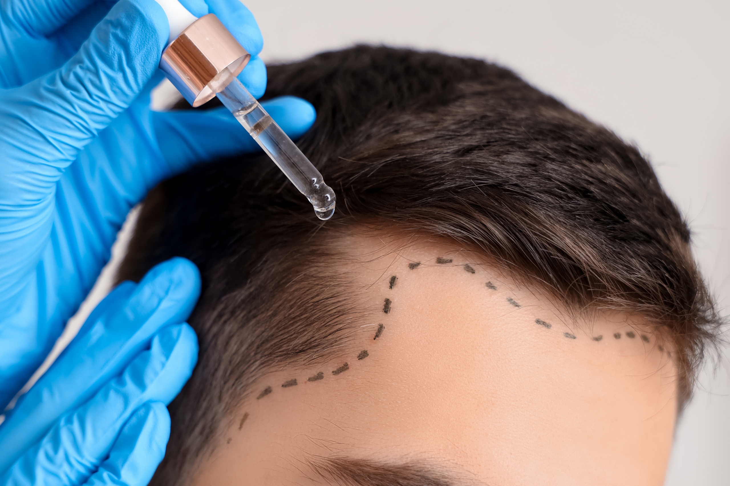 Is Turkiye Good For Hair Transplant?