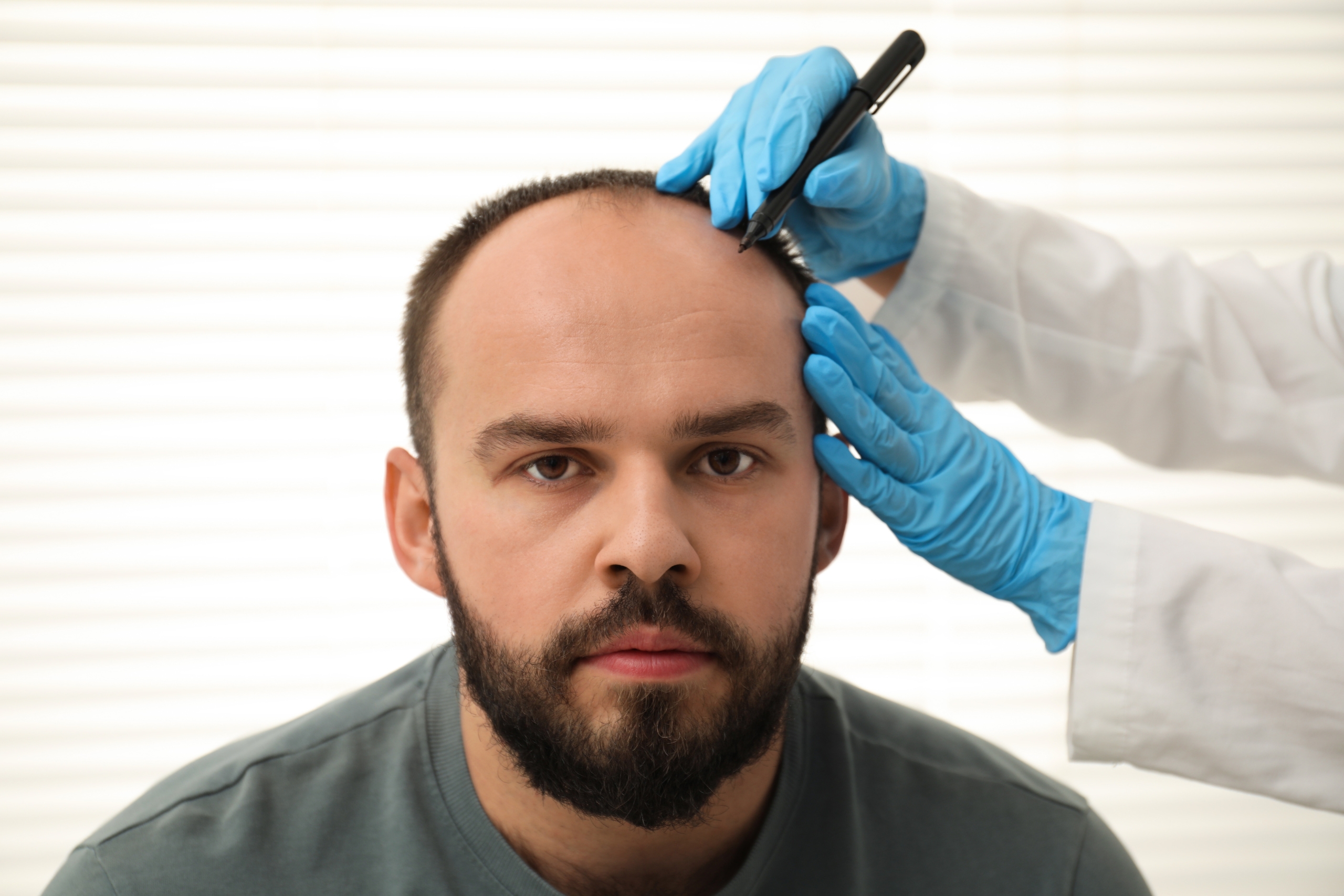 Turkey Has The World’s Leading Hair Transplant Clinics